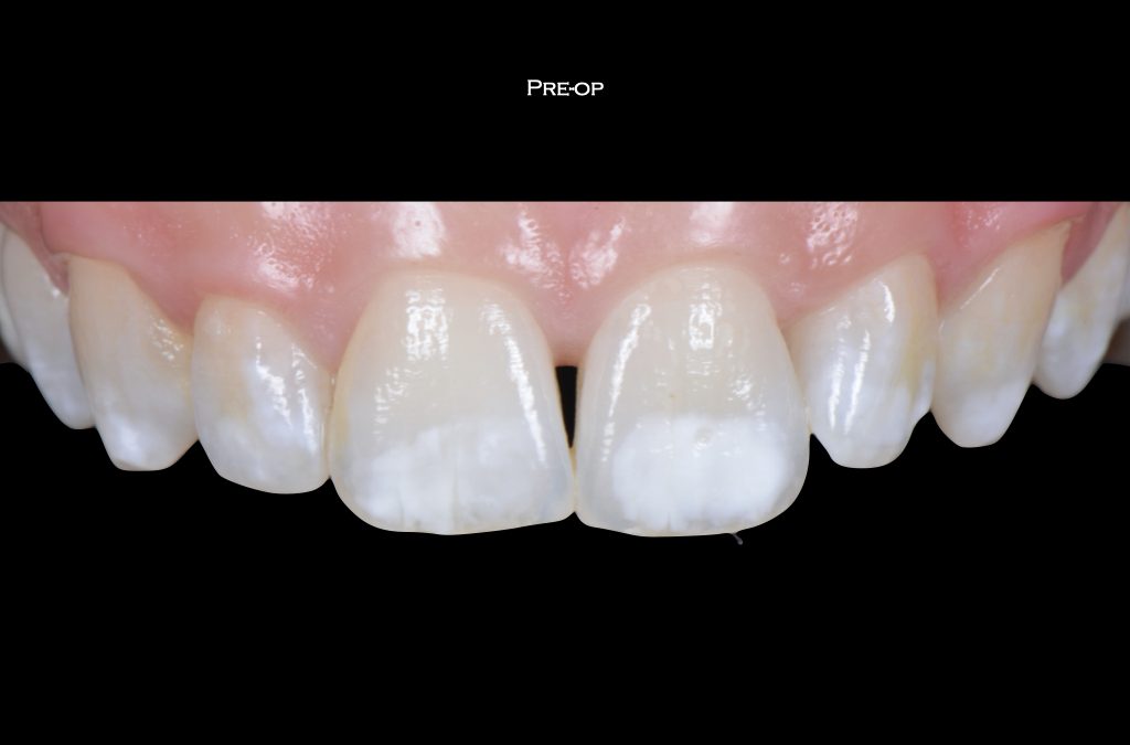WHITE SPOTS: MACCHIE BIANCHE SUI DENTI