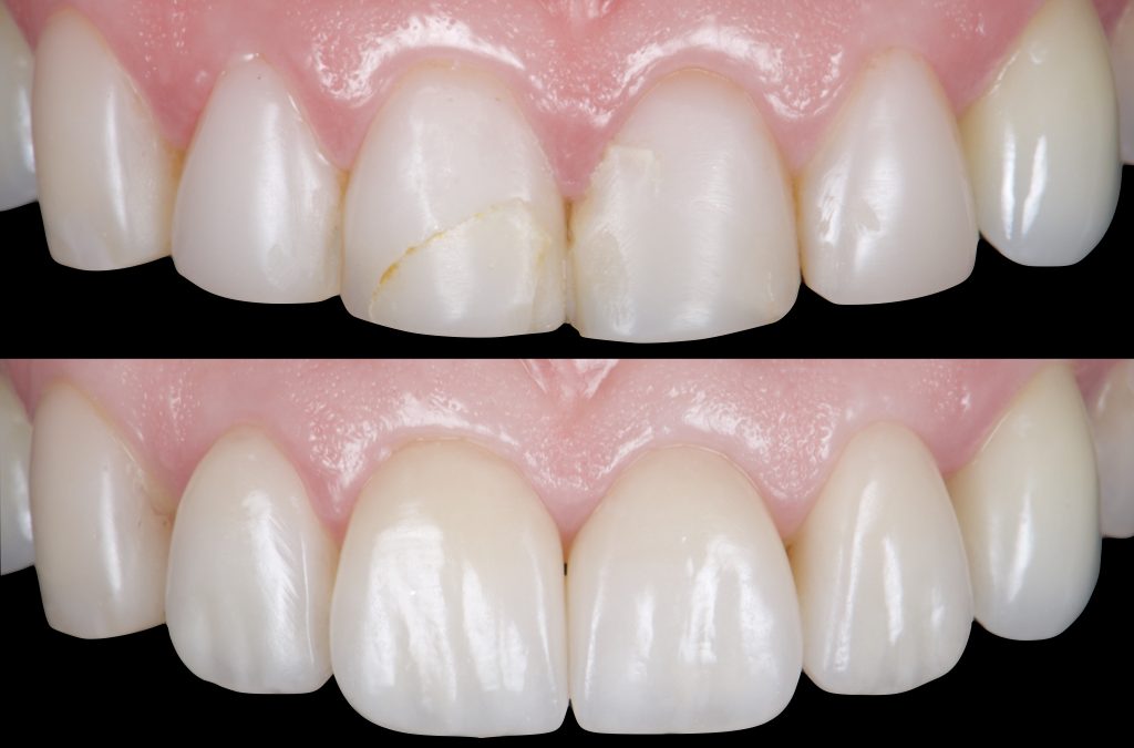 FACCETTE ESTETICHE DENTALI O VENEERS