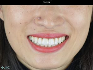 Macchie bianche denti Milano Centro