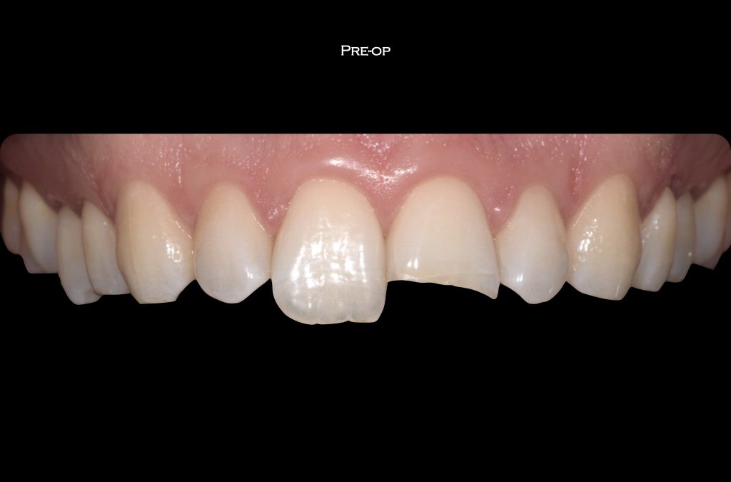 RICOSTRUZIONI ESTETICHE